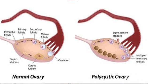 Perbandingan ovarium yang normal dan dengan sindrom ovarium polikistik - via pinimg.com
