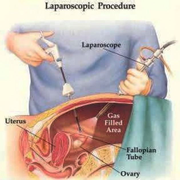 Ilustrasi laparoskopi - via blogspot.com