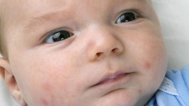 Bayi yang sedang kepanasan atau marah via www.sheknows.com